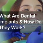 What Are Dental Implants & How Do They Work?