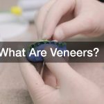 What Are Veneers?